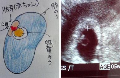 ５週６日 胎嚢と心拍確認出来ました みらころ工房